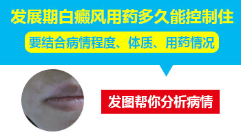诊断治疗-皮肤长白癜风的治疗要注意什么